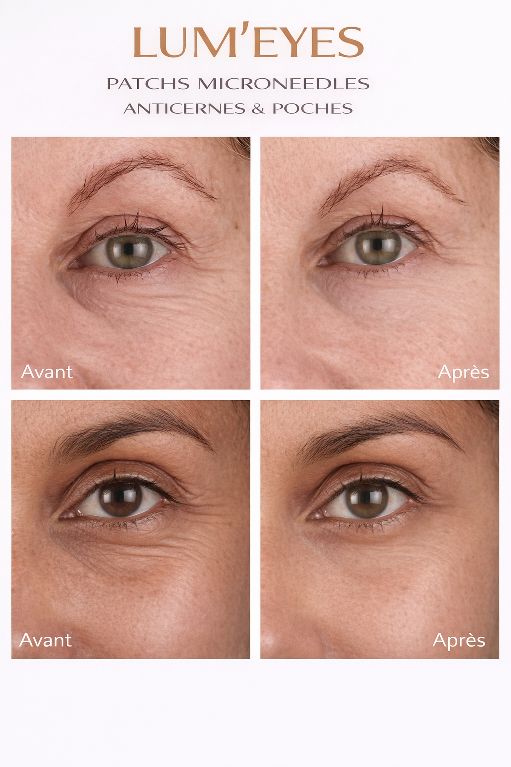 LUM’ EYES– Patchs Microneedle à l’Acide Hyaluronique – Anti-Rides & Repulpant Intensif
